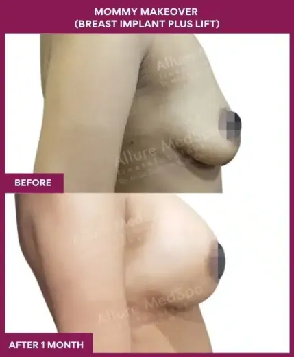 1 Mommy Makeover (BREAST LIFT)_37 (3)