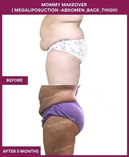 1 Mommy Makeover ( MEGALIPOSUCTION -ABDOMEN ,BACK ,THIGH) (3)_151