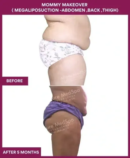 1 Mommy Makeover ( MEGALIPOSUCTION -ABDOMEN ,BACK ,THIGH) (5)_151
