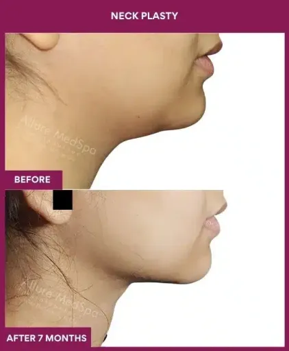 Female Neck plasty in Mumbai, India