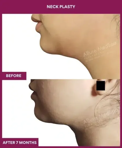 Female Neck plasty in Mumbai, India