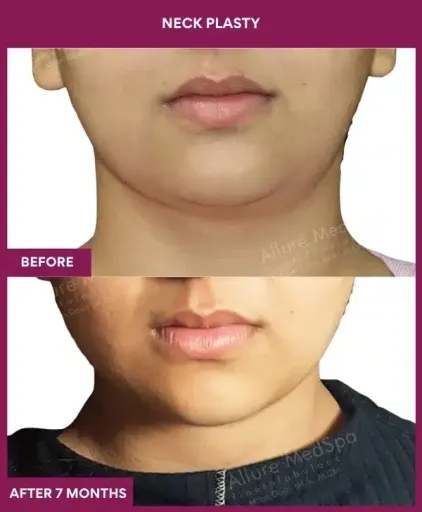 Female Neck plasty in Mumbai, India