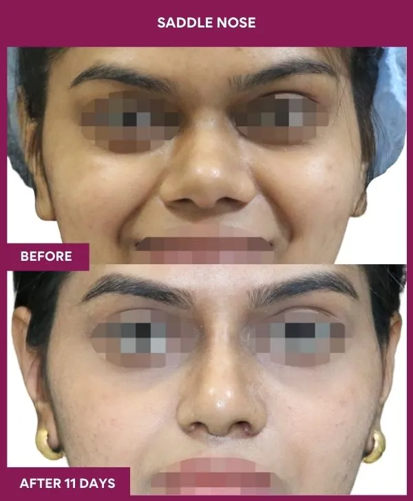 1 SADDLE NOSE_51_ (1)