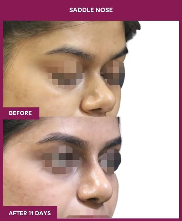 1 SADDLE NOSE_51_ (2)