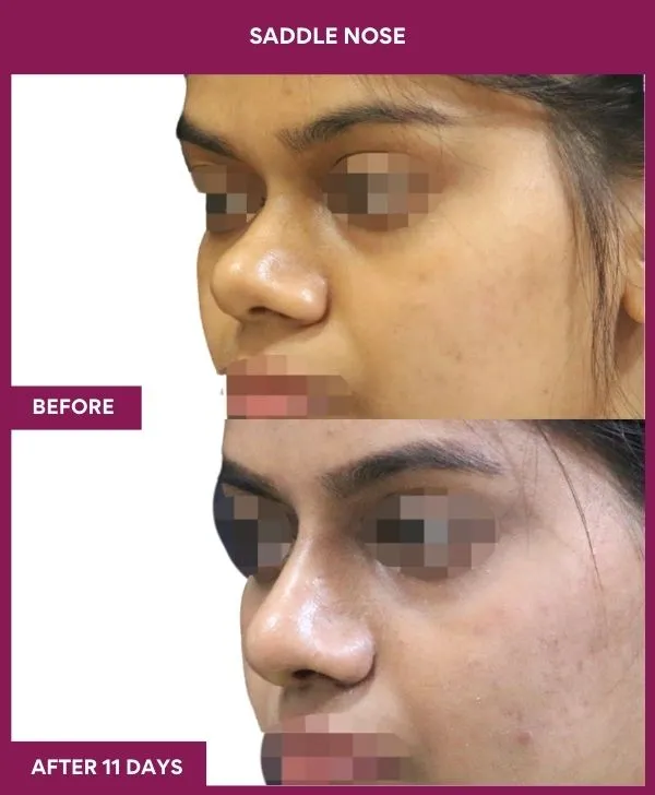 1 SADDLE NOSE_51_ (3)