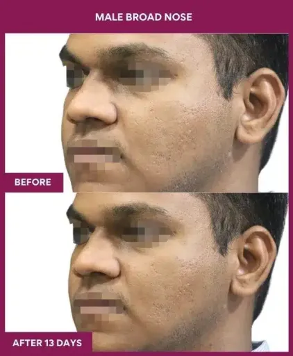 1 male broad nose in Mumbai, India