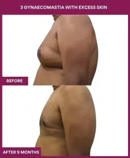 10- 3 gynaecomastia with excess skin (2)_