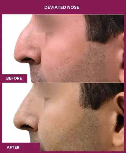 11 deviated nose_37 in Mumbai, India