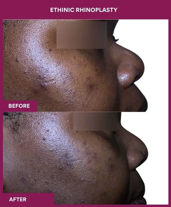 12 ETHINIC RHINOPLASTY (4)_39_