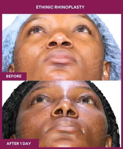 13 ETHINIC RHINOPLASTY in Mumbai, India