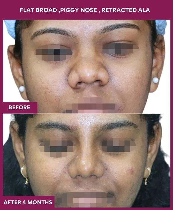 14 FLAT BROAD ,PIGGY NOSE , RETRACTED ALA_46_ (1)