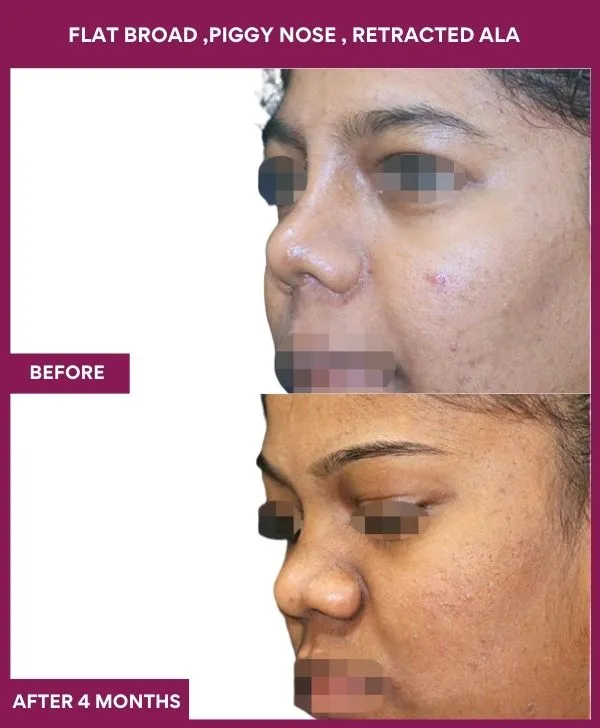 14 FLAT BROAD ,PIGGY NOSE , RETRACTED ALA_46_ (3)