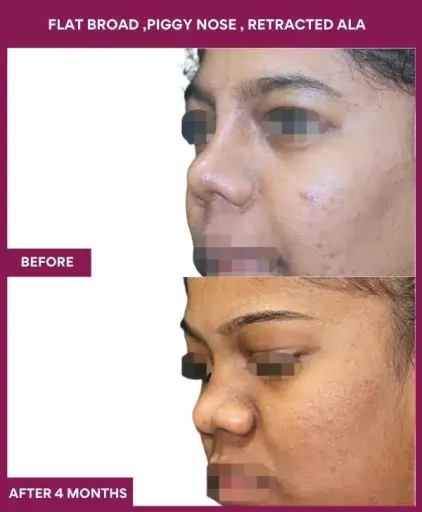 14 FLAT BROAD ,PIGGY NOSE , RETRACTED ALA in Mumbai, India