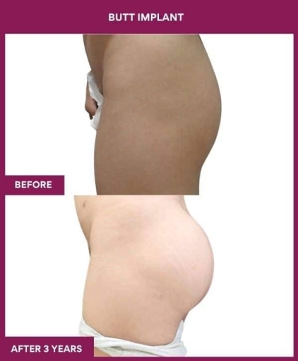 BUTT IMPLANT in Mumbai, India