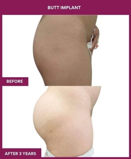 BUTT IMPLANT in Mumbai, India