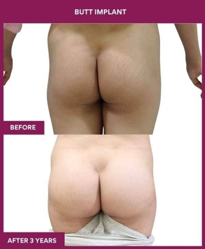 BUTT IMPLANT in Mumbai, India