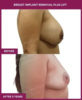 2 Breast Implant Removal Plus Lift (3)_4_