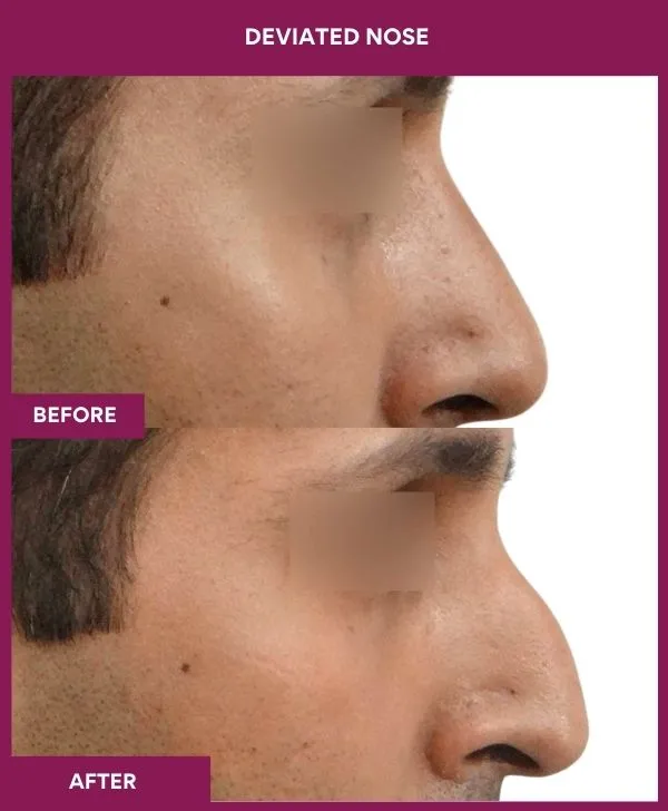 2 DEVIATED NOSE (3)_23_