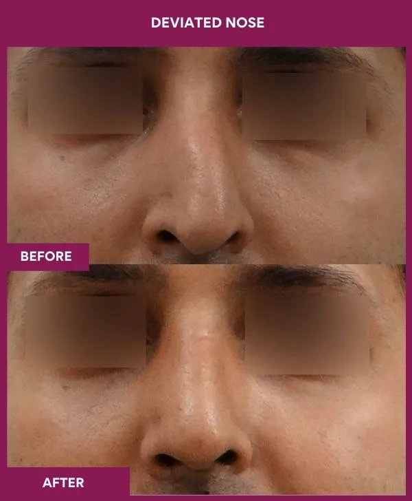 2 DEVIATED NOSE (4)_23_