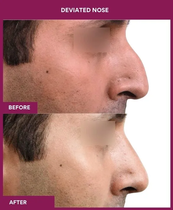 2 DEVIATED NOSE (5)_23