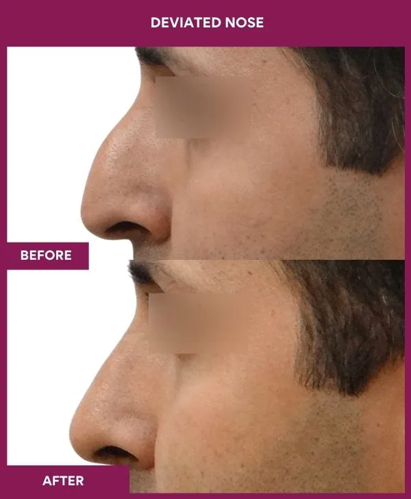 2 DEVIATED NOSE (5)_23_