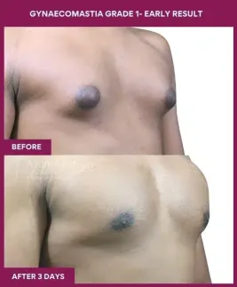 2- GYNAECOMASTIA GRADE 1- EARLY RESULT