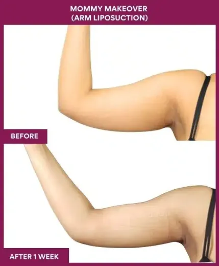 2 Mommy Makeover (Arm Liposuction) (3)_