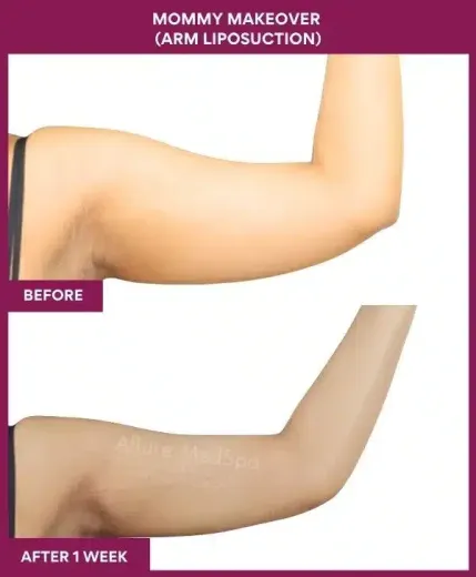 2 Mommy Makeover (Arm Liposuction) (4)_