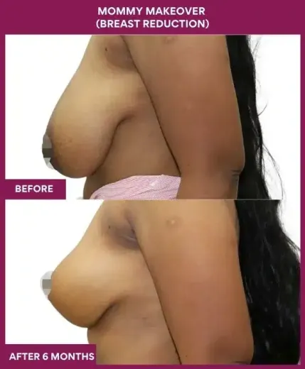 2 Mommy Makeover (Breast Reduction)_52_ (3)