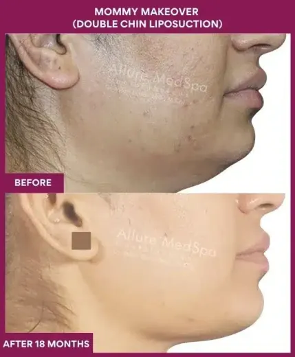 2 Mommy Makeover (DOUBLE CHIN LIPOSUCTION) (5)_82