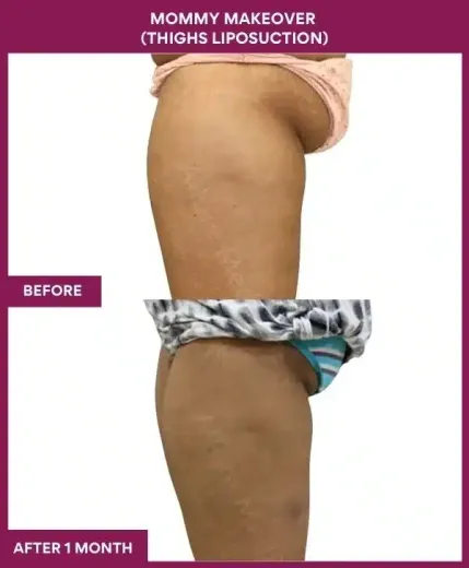 2 Mommy Makeover (Thighs Liposuction)_99 (3)