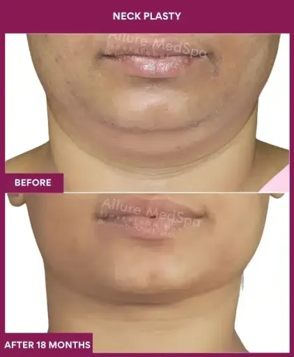 Necklift Surgery in Mumbai