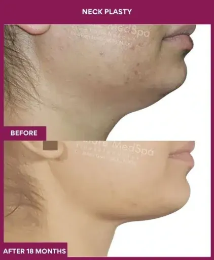 Necklift Surgery in Mumbai