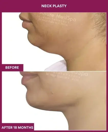 Necklift Surgery in Mumbai