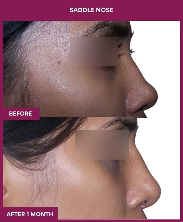 2 SADDLE NOSE (3)_53_