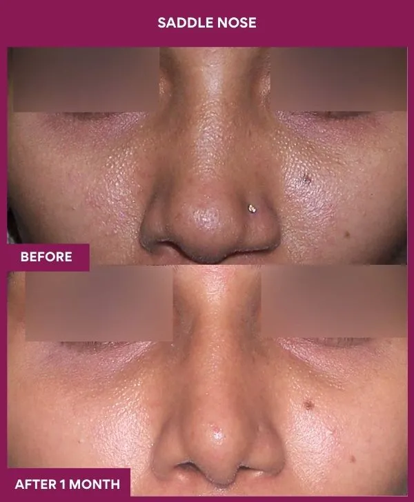 2 SADDLE NOSE (4)_53_