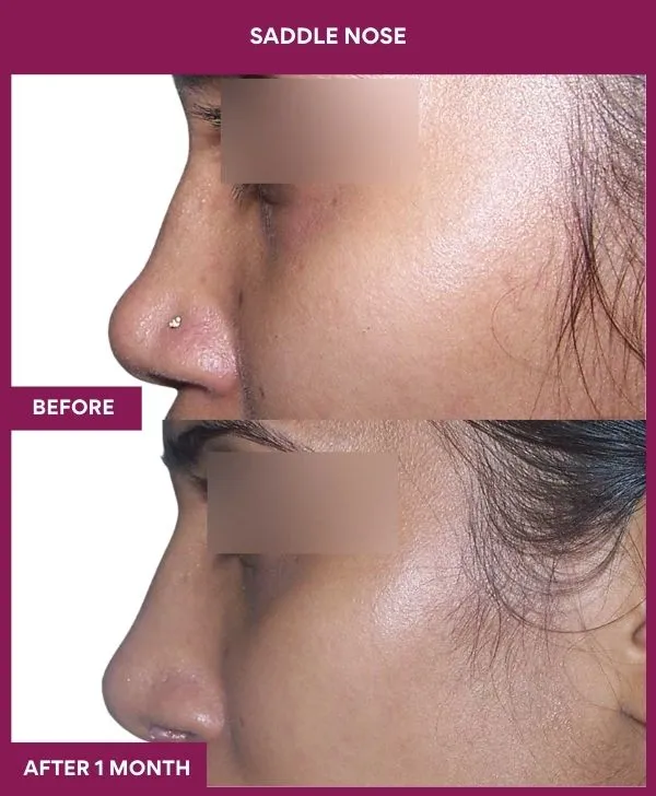 2 SADDLE NOSE (5)_53_