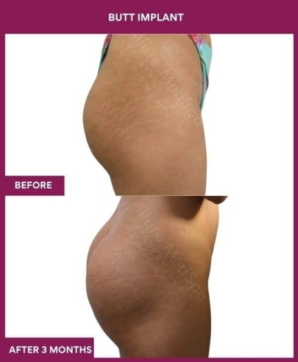 3 BUTT IMPLANT in Mumbai, India