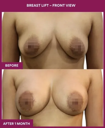 3 Breast Lift – Front View_7