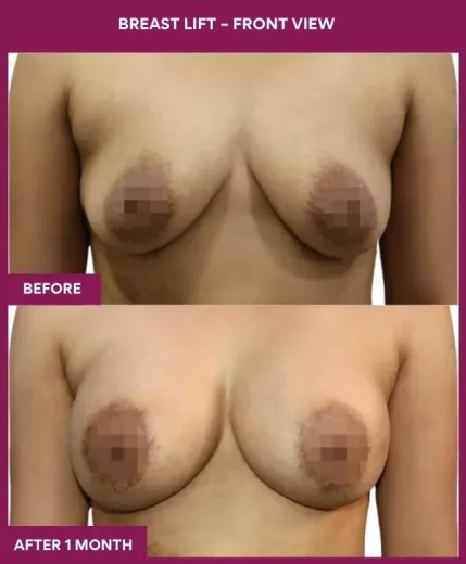3 Breast Lift – Front View_7