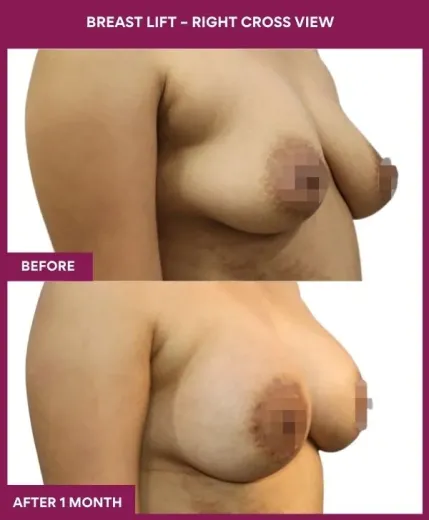 3 Breast Lift – Right Cross View_8
