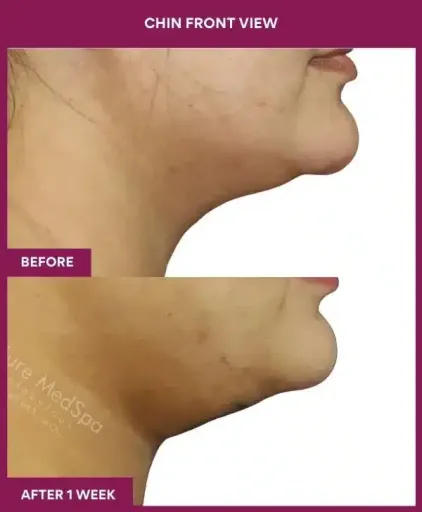 Female Necklift Surgery in Mumbai