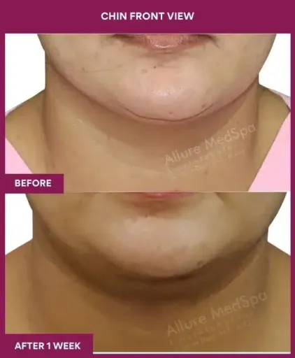 Female Necklift Surgery in Mumbai