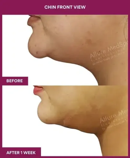 Female Necklift Surgery in Mumbai