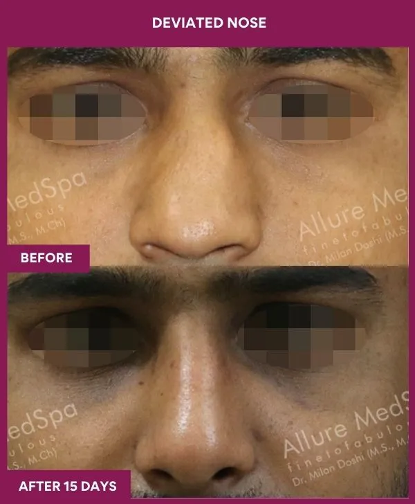 3 DEVIATED NOSE_27_ (1)