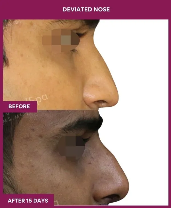 3 DEVIATED NOSE_27_ (2)