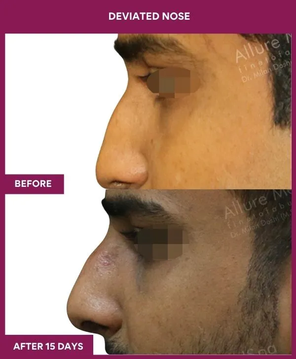 3 DEVIATED NOSE_27_ (3)