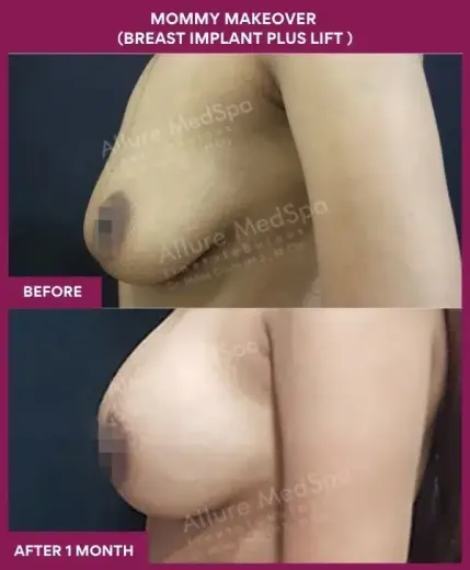 3 Mommy Makeover (BREAST IMPLANT PLUS LIFT ) (5)_