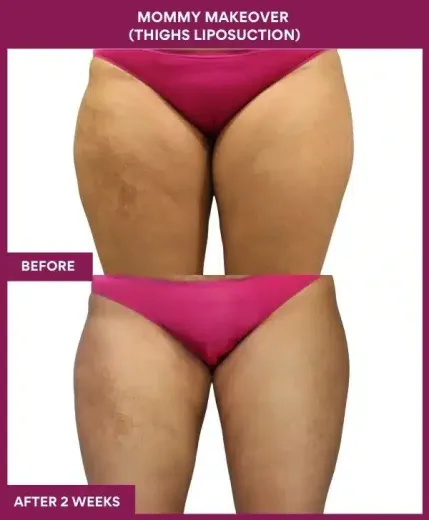 3 Mommy Makeover (Thighs Liposuction) (4)_101