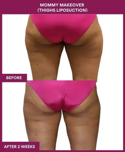 3 Mommy Makeover (Thighs Liposuction) (5)_101